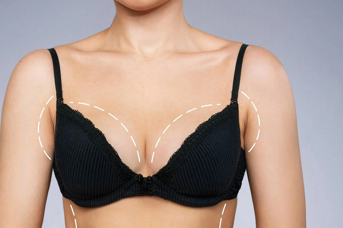 Breast Augmentation