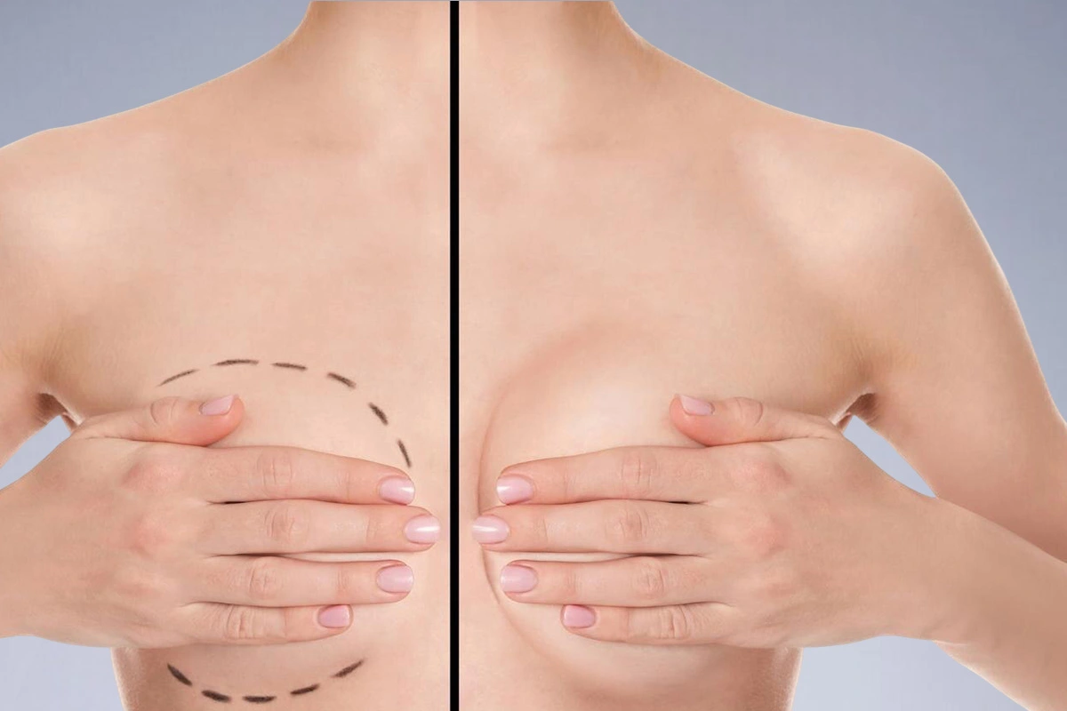 Breast Augmentation Risks